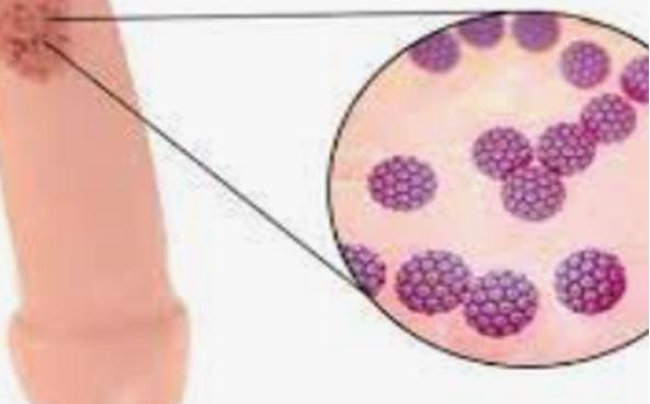 LA CHLAMYDIA, TRAITEMENT, CAUSE, SYMPTÔME, MÉTHODES PRÉVENTIVES