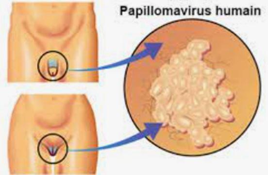 CHLAMYDIA, TRAITEMENT, CAUSES, SYMPTÔMES, ET PRÉVENTION