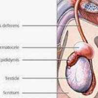 Epididymis spermatocele 1