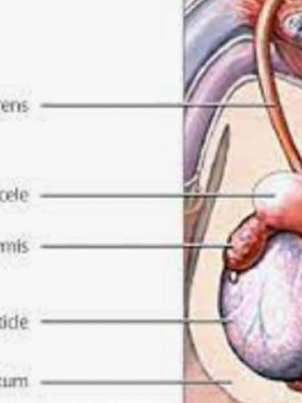 Epididymis spermatocele 1