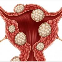 Fibrome uterin dans uterus