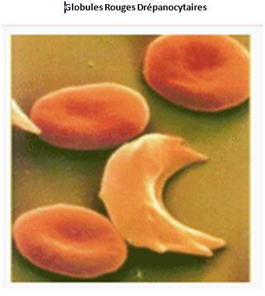 Globules rouges drepanocytaires 1
