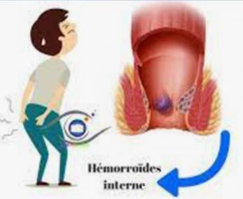 Hemorroides internes