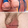 Hydrocele aux testicules