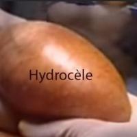 Hydrocele maladie homme