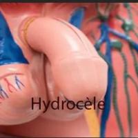 Hydrocele testicules