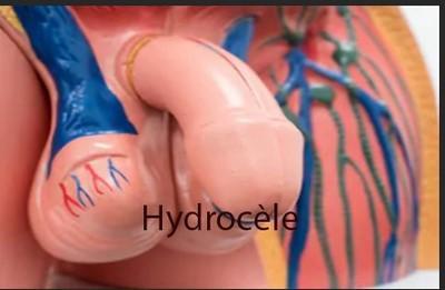 Hydrocele testicules