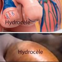 Hydrocele vaginale