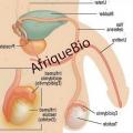 Hydrocele