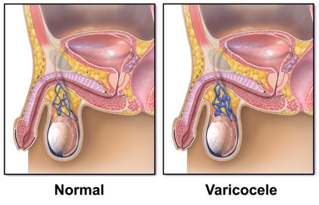 Comment Soigner Naturellement une Varicocéle ?