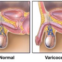 Image varicocele