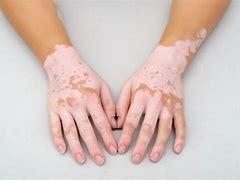 Vitiligo: understanding, causes, symptoms, and management