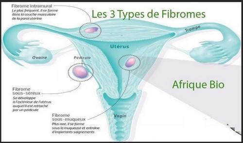 Fibrome et Kigelia Africana, Kyste et Kigelia Africana