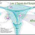 Ok les 3 types de fibromes