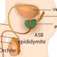 Orchite epididymite