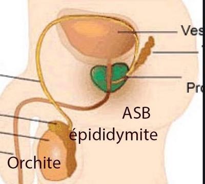 Orchite epididymite