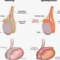 Orchitis epididymitis 1