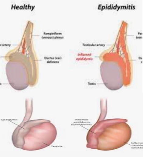 Orchitis epididymitis 1