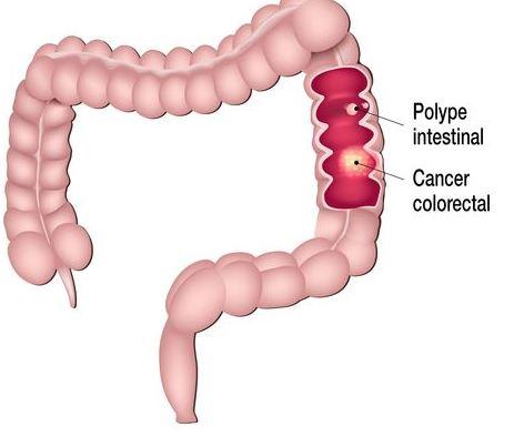 SYNDROME DE COLON IRRITABLE TRAITEMENT