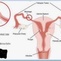 Polype fibrome kyste trompes bouchees