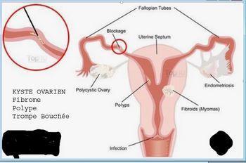 Polype fibrome kyste trompes bouchees