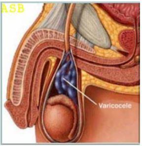 Plante Pour Soigner La Varicocèle : définition et causes