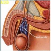 Remede 058 varicocele 1