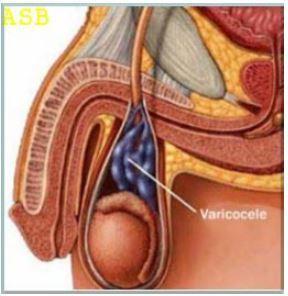 Remede 058 varicocele 1