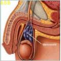 Remede 058 varicocele