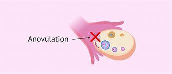 Natural Treatment to Cure Anovulation