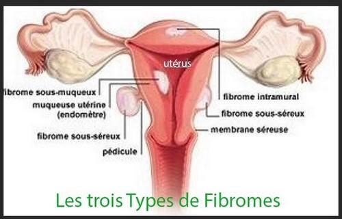 Trois types fibromes asb