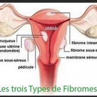 Trois types fibromes asb
