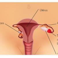 Trompes et uterus
