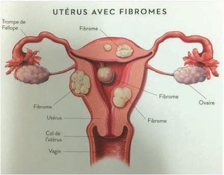 Plantes Africaines Pour Guérir Fibromes Myomes