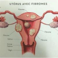 Uterus avec fibrome