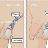 Varicocele asb copier 