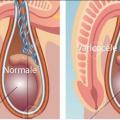 Varicocele varice des testicules asb copier 1