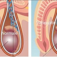 Varicocele varice des testicules asb copier 