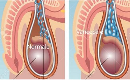 Varicocele varice des testicules asb copier 