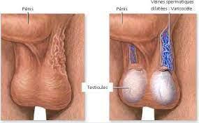 Tratamiento natural para el varicocele